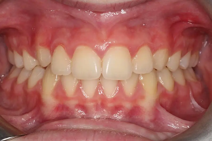 Before Intraoral Centre Tooth Photo