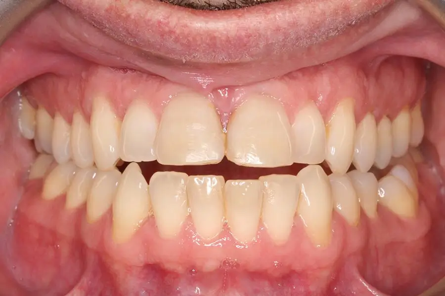 Before Intraoral Centre Tooth Photo