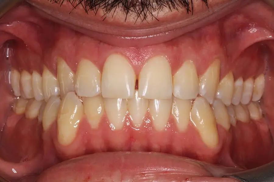 Before Intraoral Centre Tooth Photo