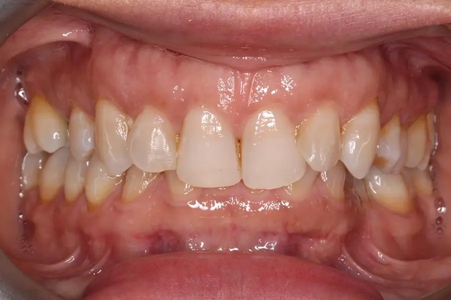Before Intraoral Centre Tooth Photo
