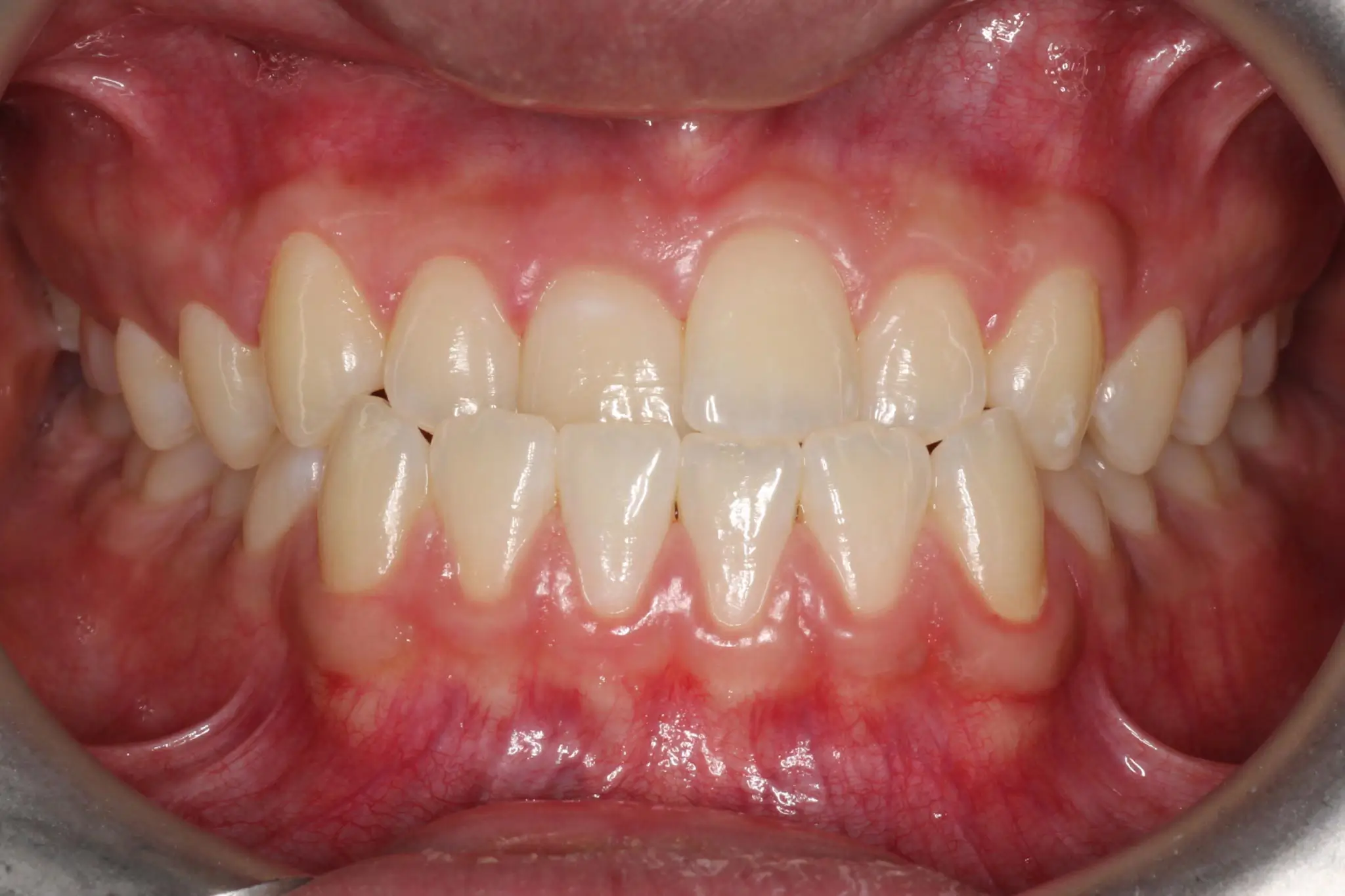 Before Intraoral Centre Tooth Photo