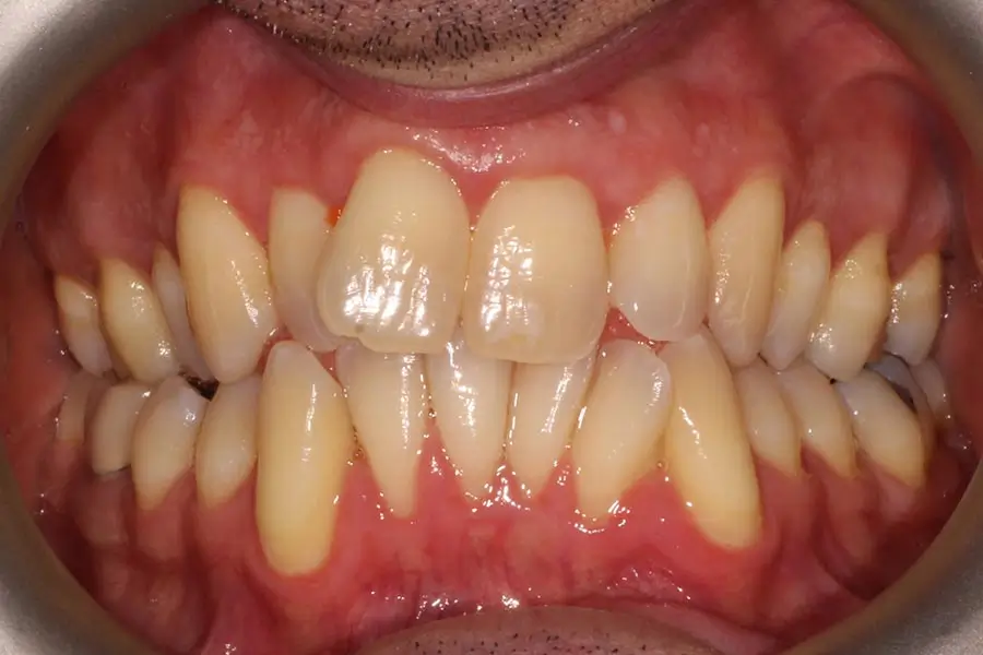 Before Intraoral Centre Tooth Photo