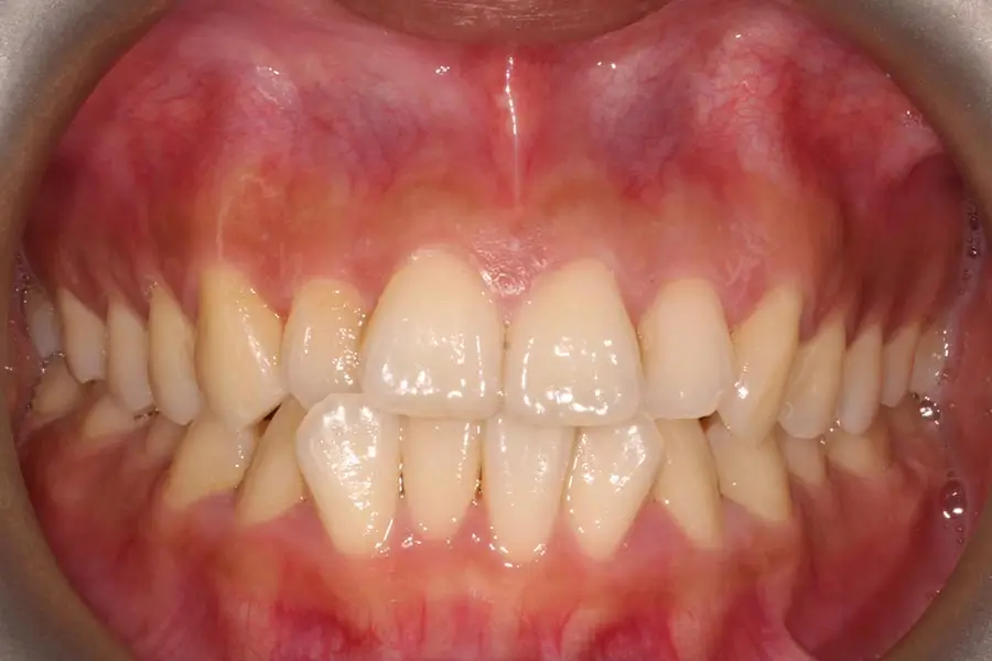 Before Intraoral Centre Tooth Photo