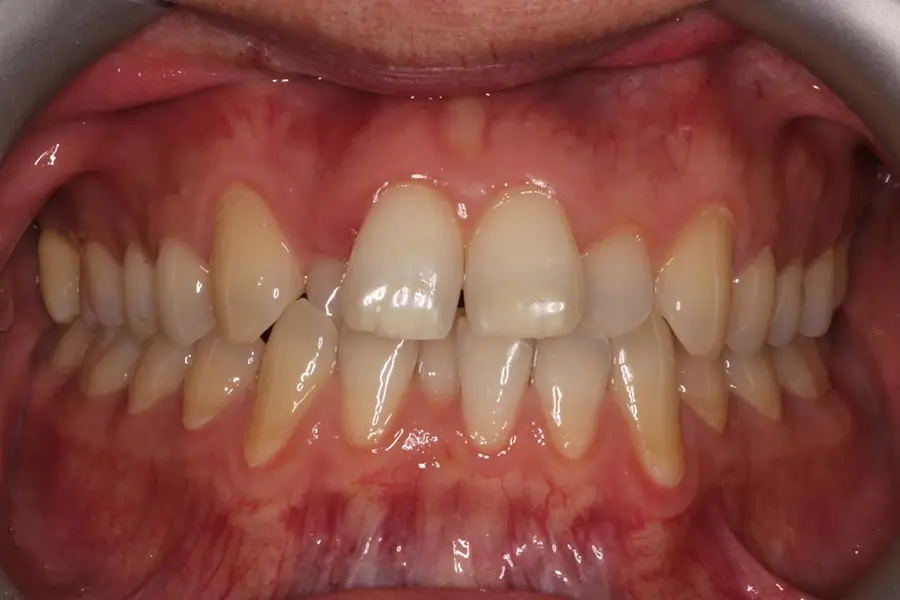 Before Intraoral Centre Tooth Photo