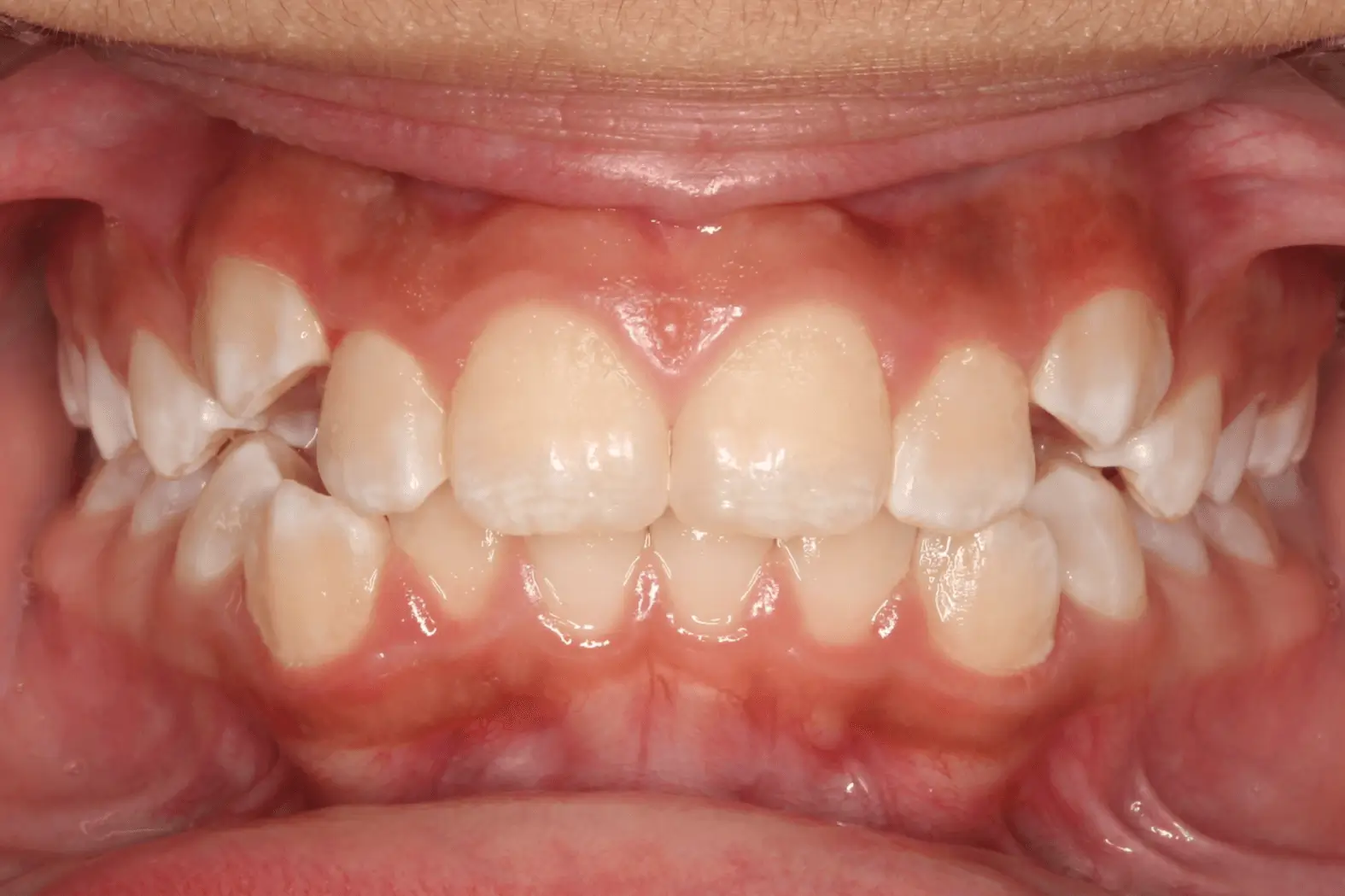 Before Intraoral Centre Tooth Photo