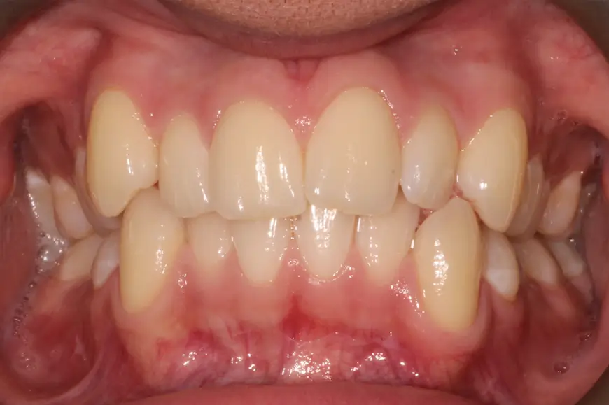 Before Intraoral Centre Tooth Photo