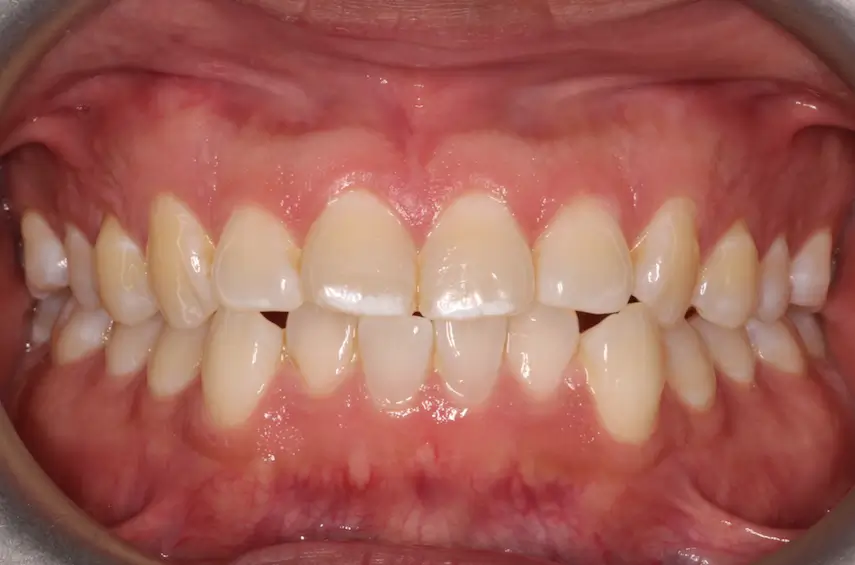Before Intraoral Centre Tooth Photo