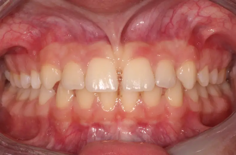 Before Intraoral Centre Tooth Photo