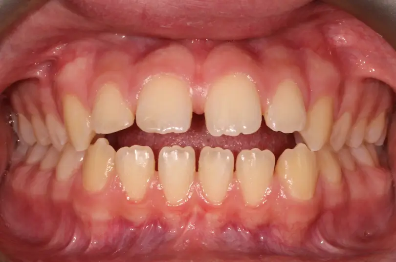 Before Intraoral Centre Tooth Photo