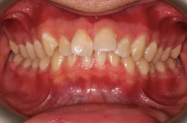 Before Intraoral Centre Tooth Photo