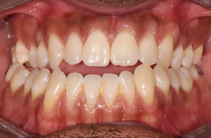 Before Intraoral Centre Tooth Photo