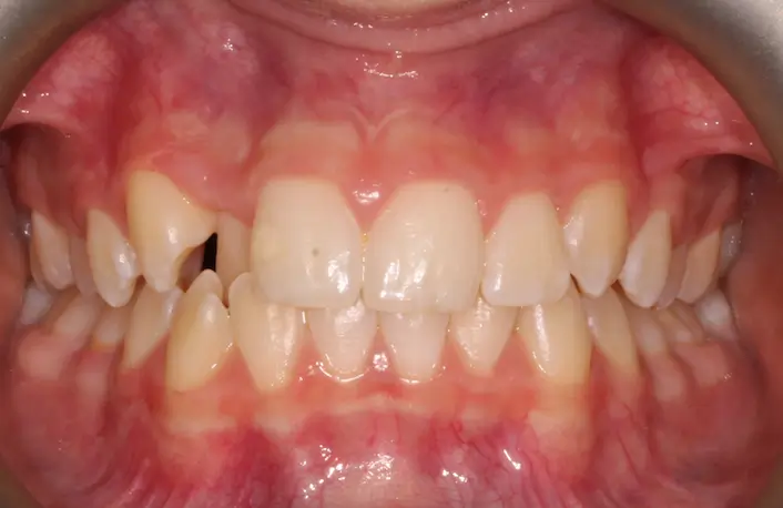 Before Intraoral Centre Tooth Photo