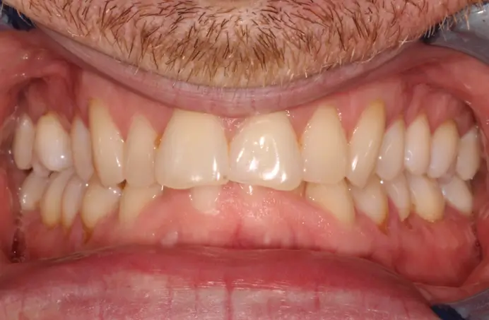 Before Intraoral Centre Tooth Photo