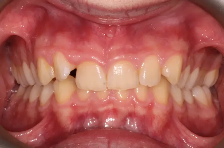 Before Intraoral Centre Tooth Photo