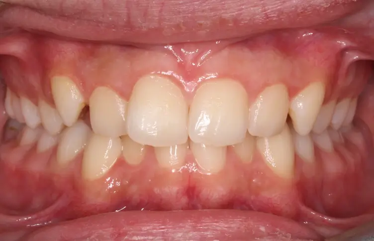 Before Intraoral Centre Tooth Photo