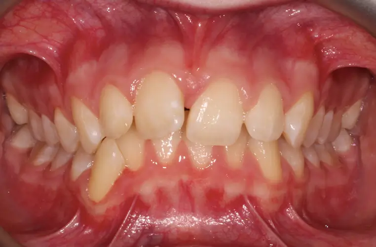 Before Intraoral Centre Tooth Photo