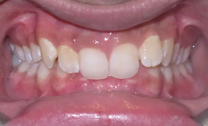 Before Intraoral Centre Tooth Photo