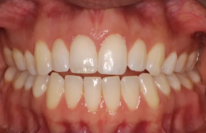 Before Intraoral Centre Tooth Photo