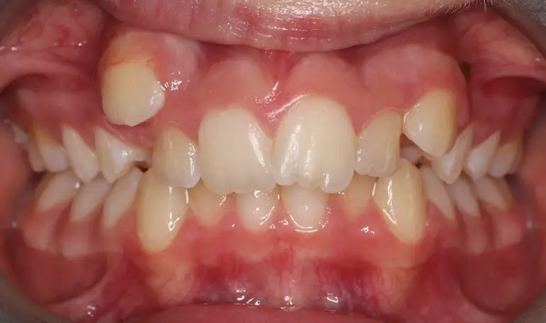 Before Intraoral Centre Tooth Photo