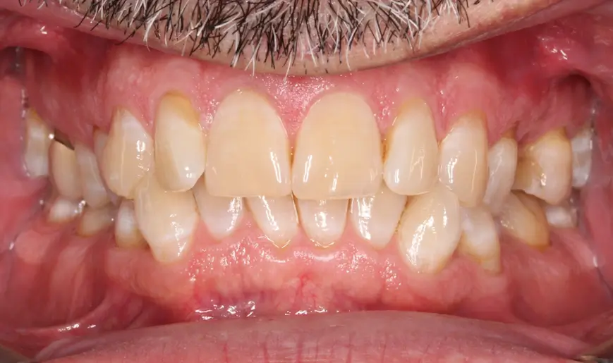 Before Intraoral Centre Tooth Photo
