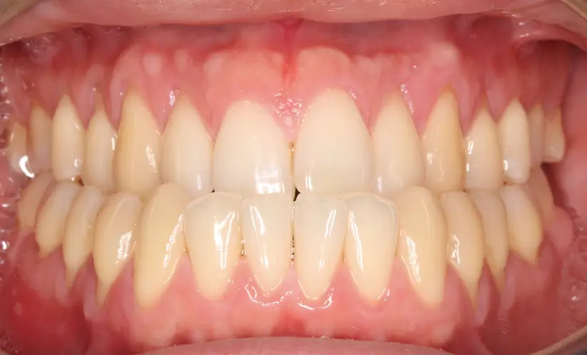Before Intraoral Centre Tooth Photo