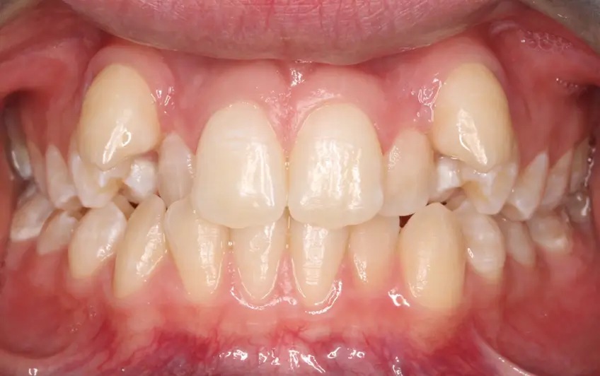 Before Intraoral Centre Tooth Photo