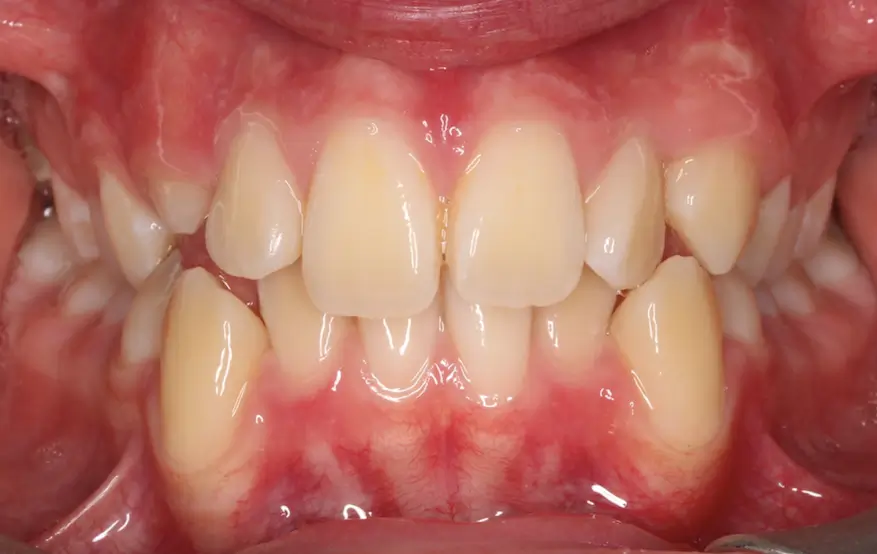 Before Intraoral Centre Tooth Photo
