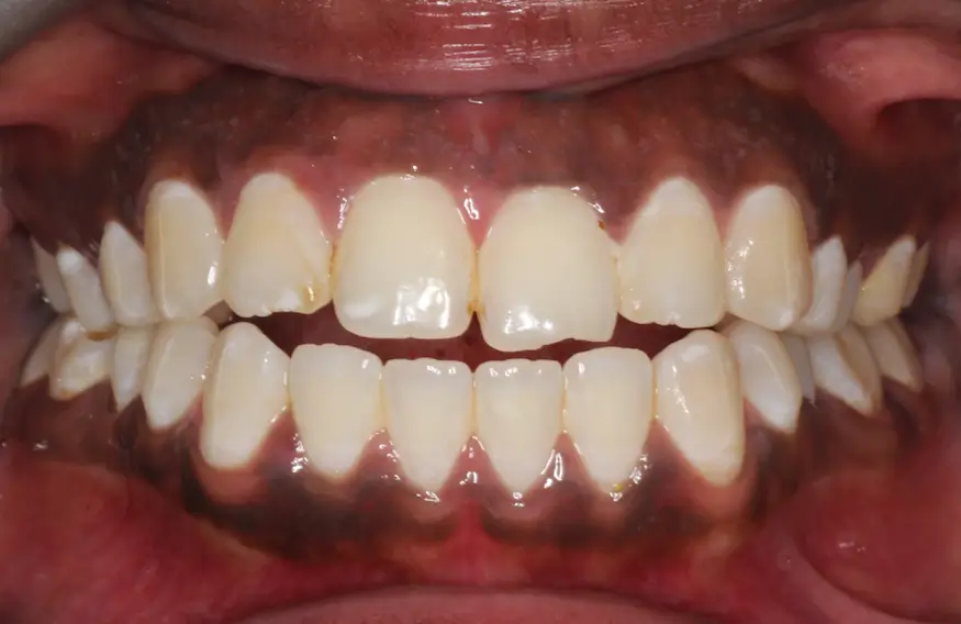 Before Intraoral Centre Tooth Photo