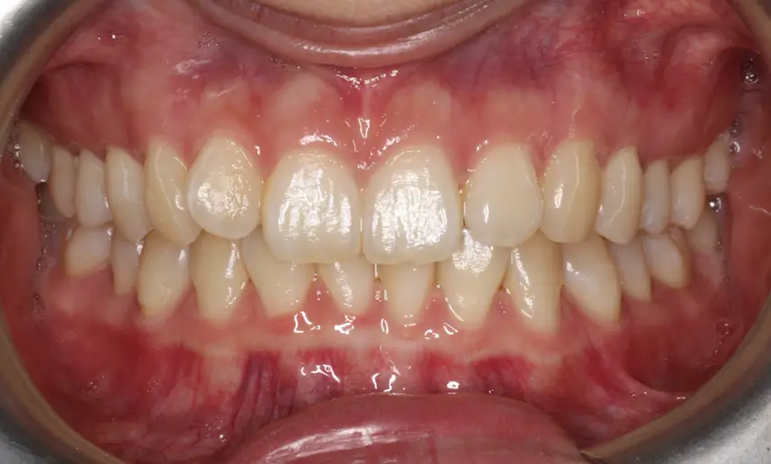 Before Intraoral Centre Tooth Photo