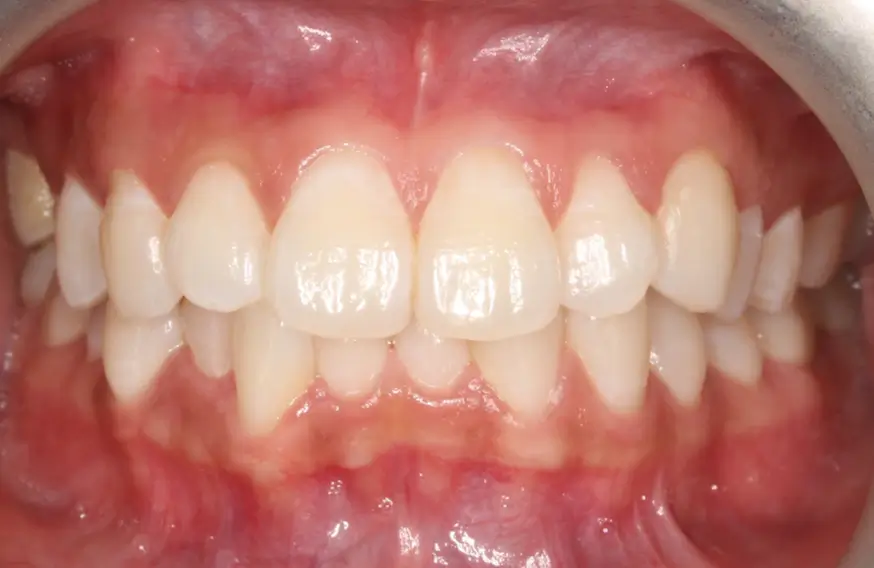 Before Intraoral Centre Tooth Photo