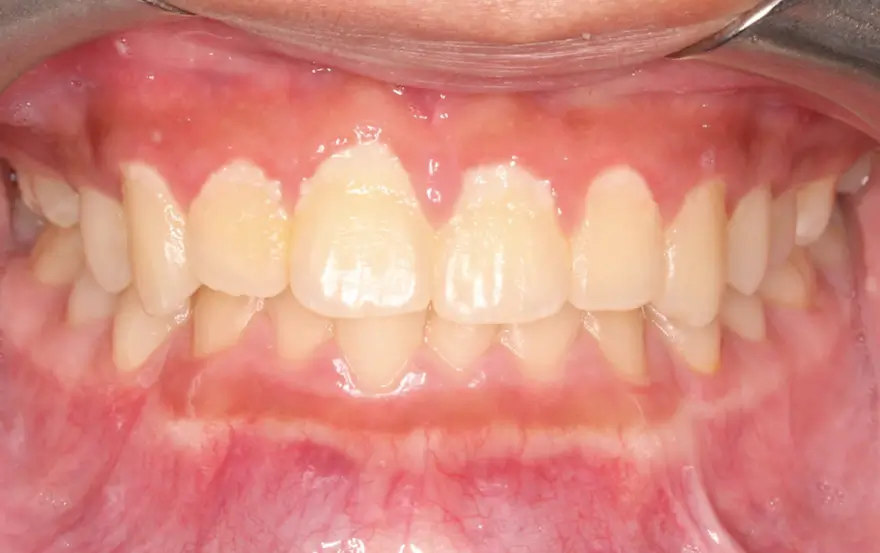 Before Intraoral Centre Tooth Photo