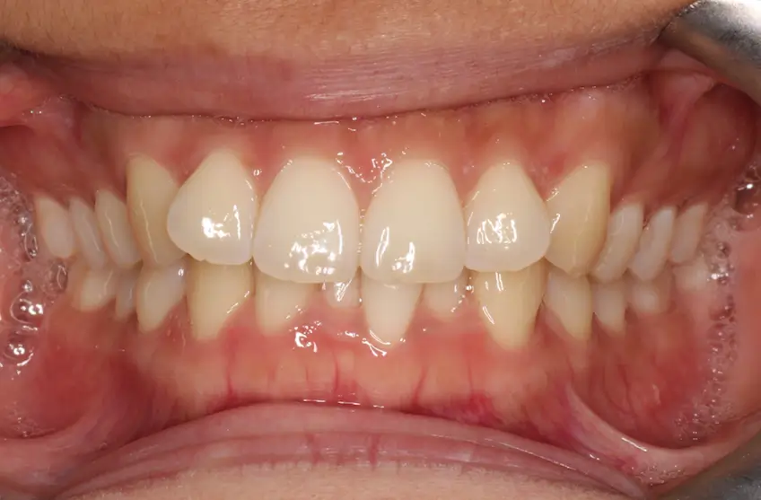 Before Intraoral Centre Tooth Photo