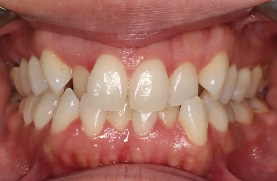 Before Intraoral Centre Tooth Photo