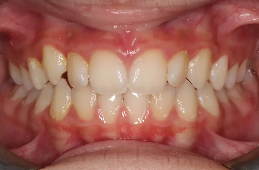 Before Intraoral Centre Tooth Photo