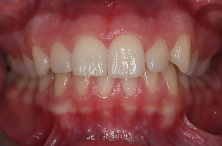 Before Intraoral Centre Tooth Photo