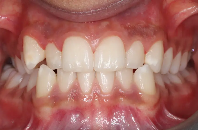 Before Intraoral Centre Tooth Photo