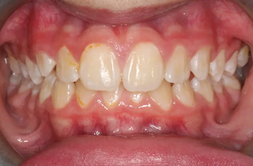 Before Intraoral Centre Tooth Photo