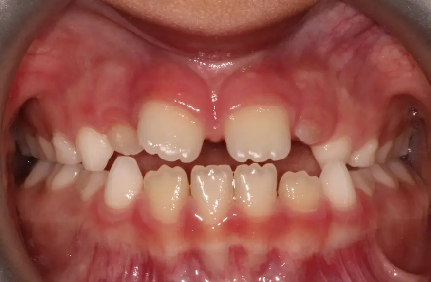 Before Intraoral Centre Tooth Photo
