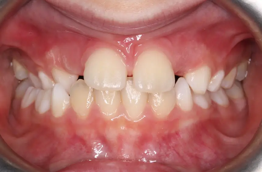 Before Intraoral Centre Tooth Photo