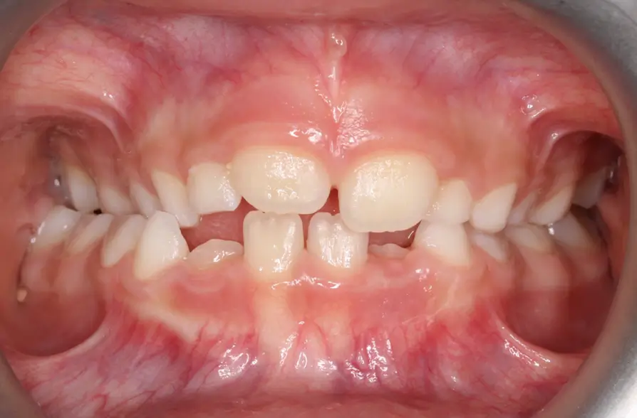 Before Intraoral Centre Tooth Photo
