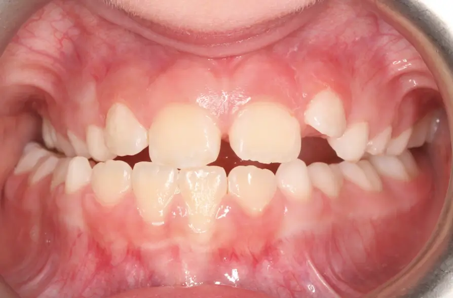 Before Intraoral Centre Tooth Photo