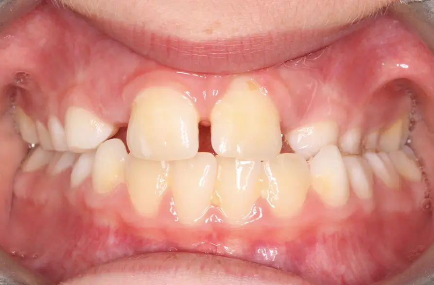 Before Intraoral Centre Tooth Photo