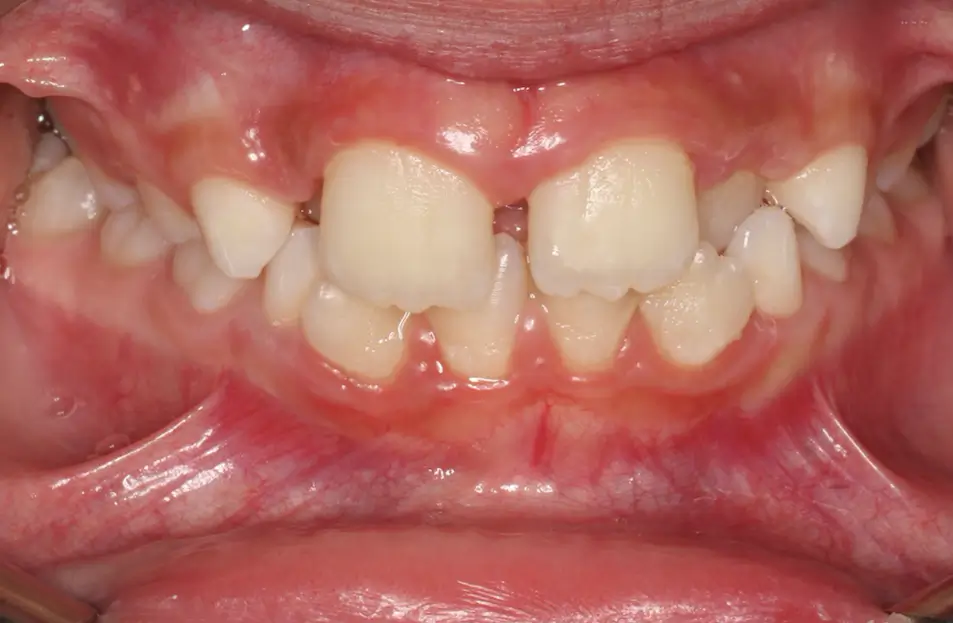 Before Intraoral Centre Tooth Photo