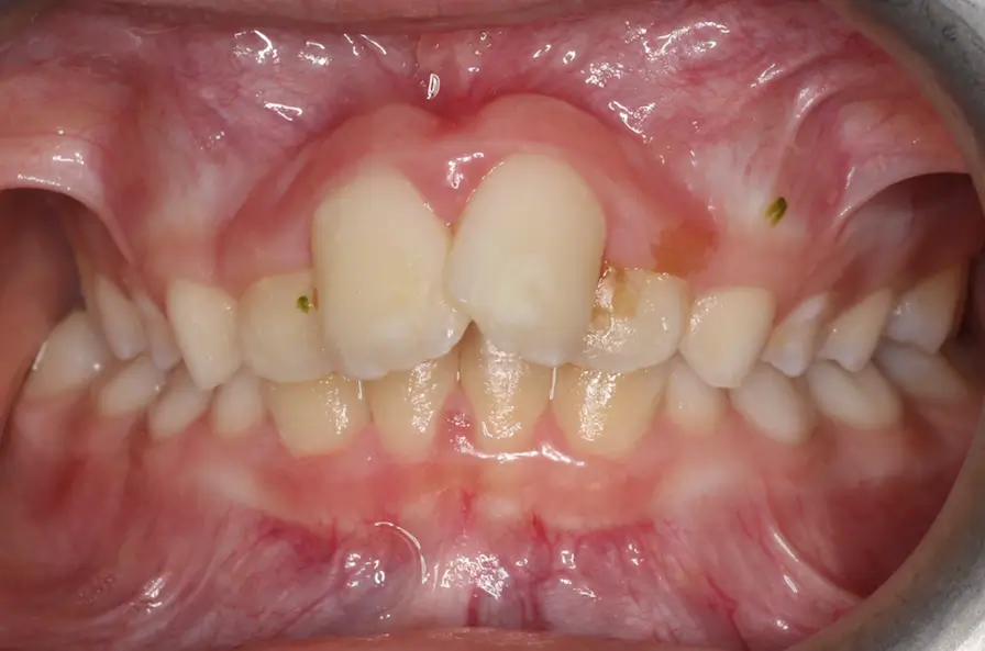 Before Intraoral Centre Tooth Photo