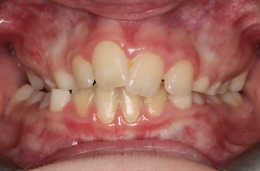 Before Intraoral Centre Tooth Photo