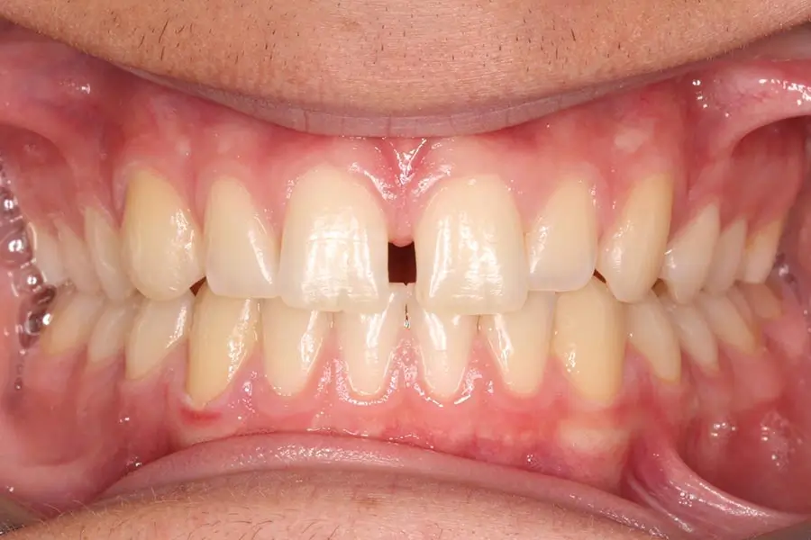 Before Intraoral Centre Tooth Photo