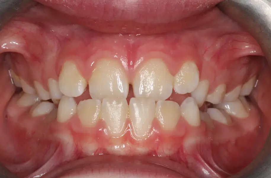 Before Intraoral Centre Tooth Photo
