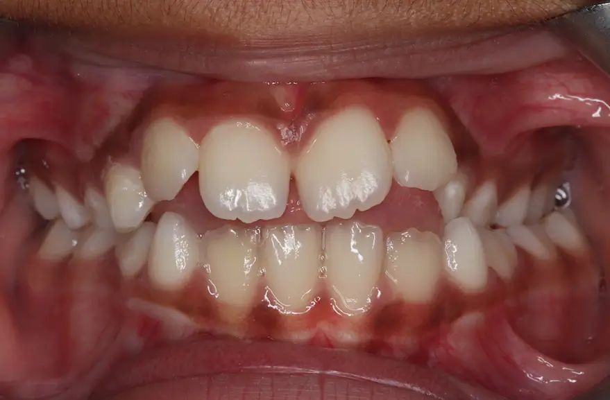 Before Intraoral Centre Tooth Photo