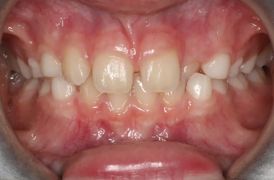 Before Intraoral Centre Tooth Photo