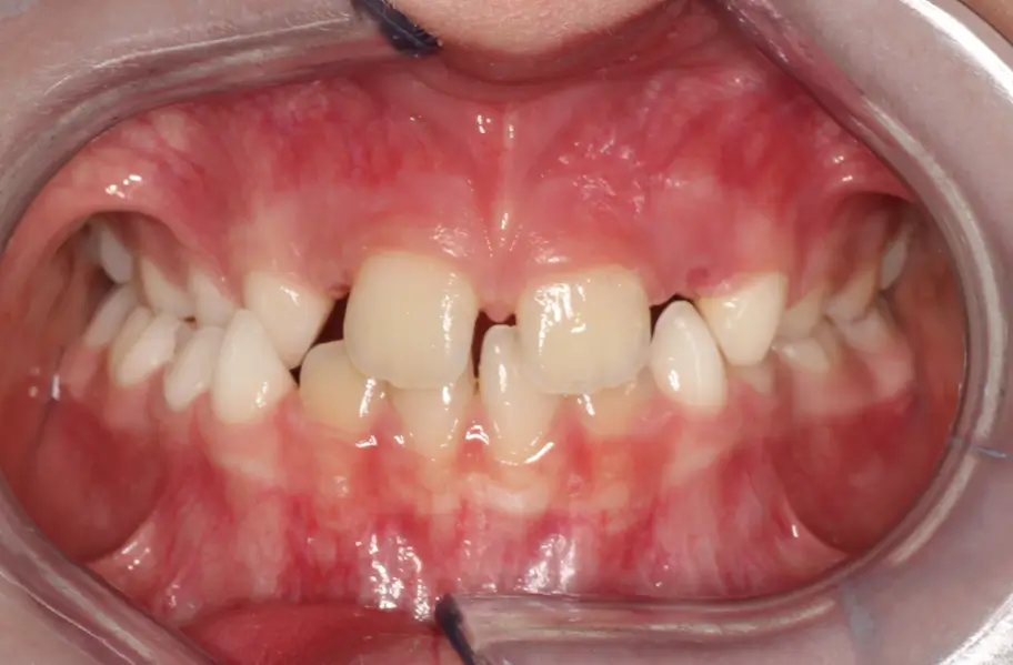 Before Intraoral Centre Tooth Photo